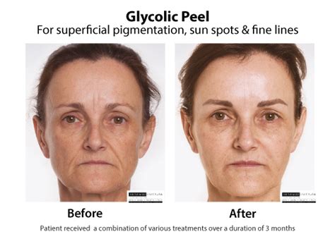 glycolic peel results|Iba pa.